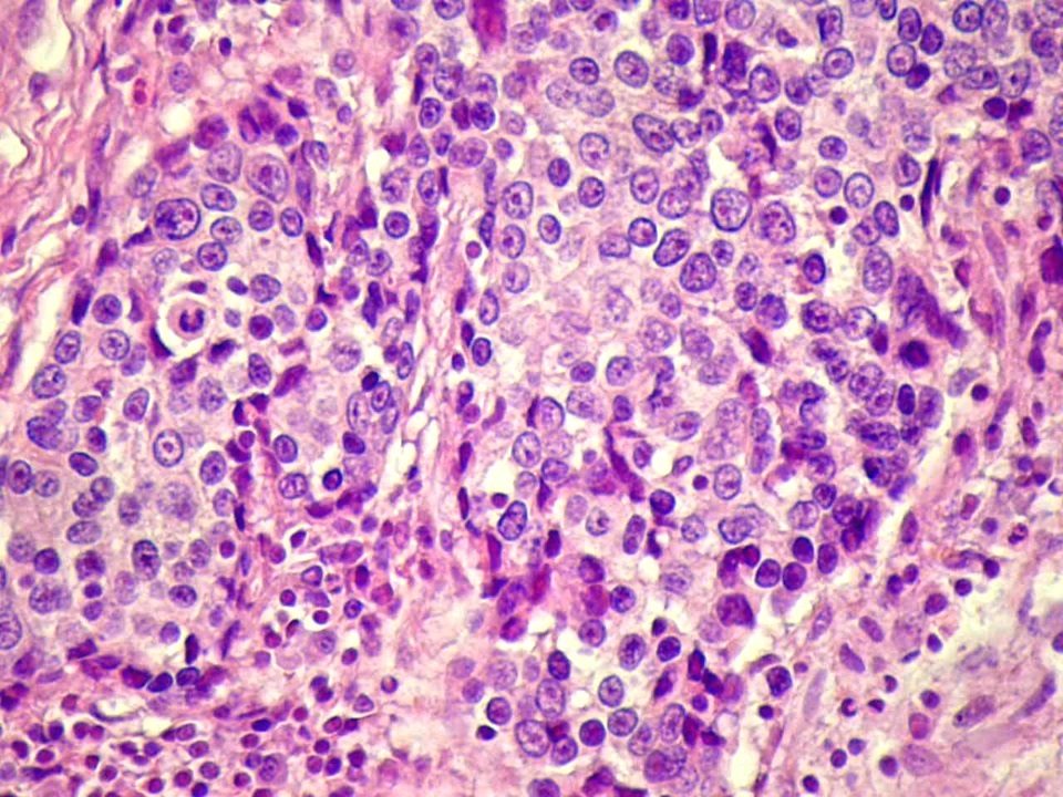 Grade III-as emlőmirigy-carcinoma(rák), tömör, solid daganatsej-szigetekkel